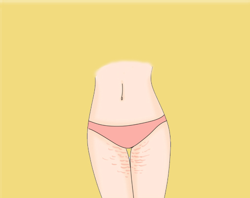 大腿妊娠纹