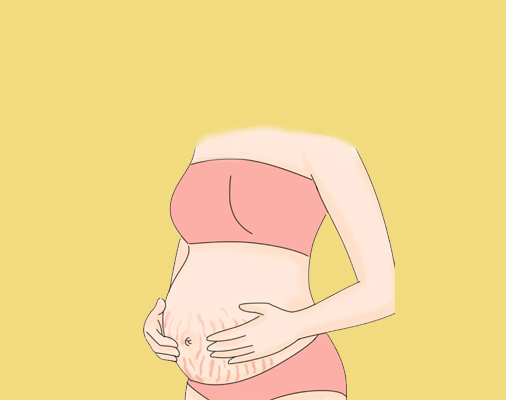 腹部妊娠纹