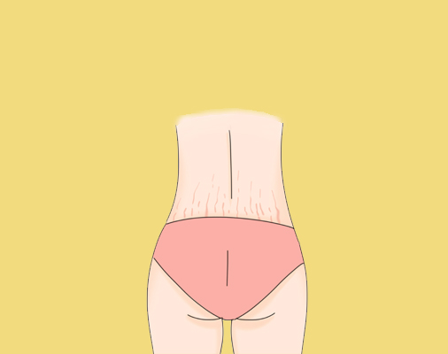 腰部妊娠纹