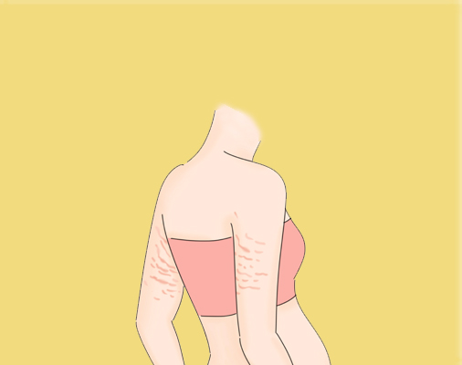 手臂妊娠纹