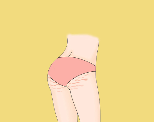 臀部妊娠纹