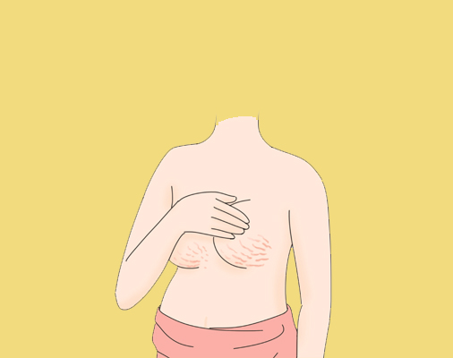胸部妊娠纹